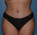 Tummy Tuck