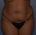 Tummy Tuck