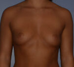 Breast Augmentation Implants