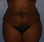 Tummy Tuck