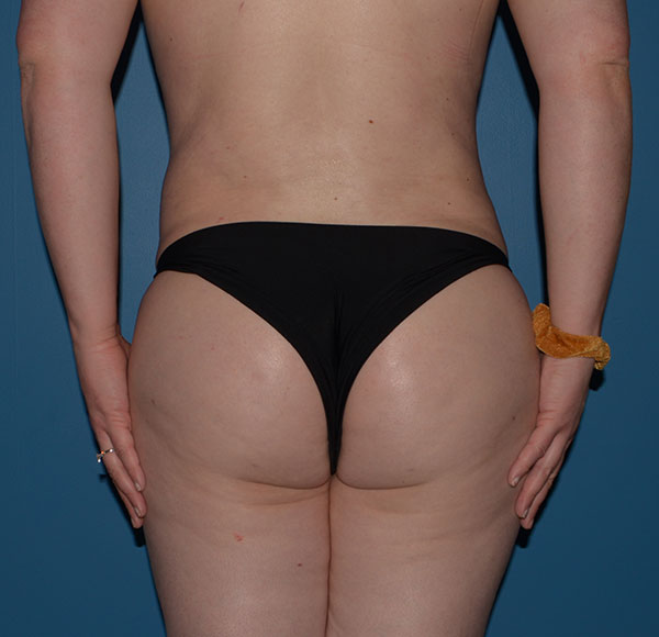 Transgender Brazilian Butt Lift BBL