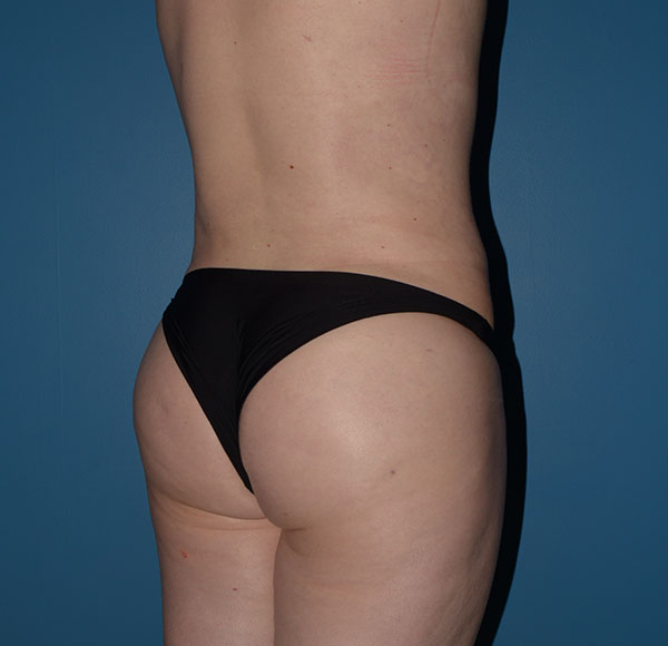 Transgender Brazilian Butt Lift BBL