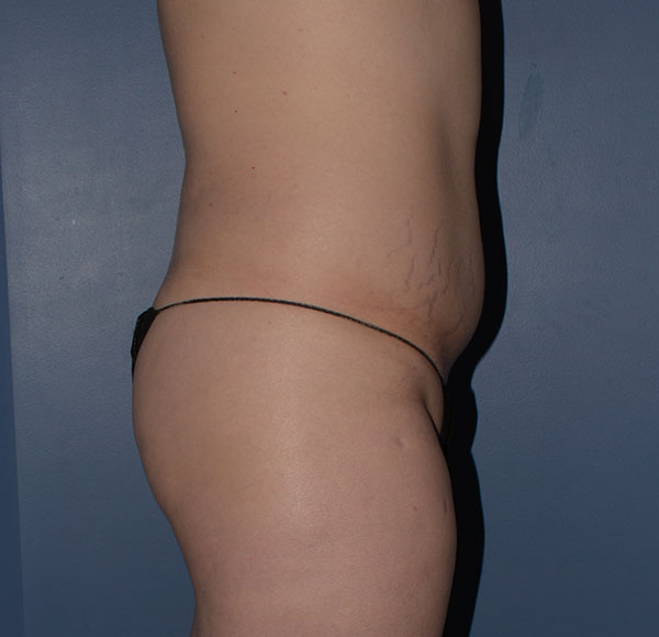 Transgender Brazilian Butt Lift BBL