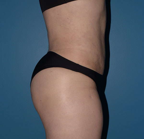 Transgender Brazilian Butt Lift BBL