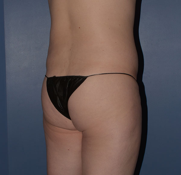 Transgender Brazilian Butt Lift BBL