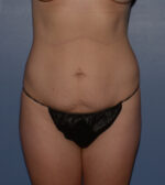 Tummy Tuck