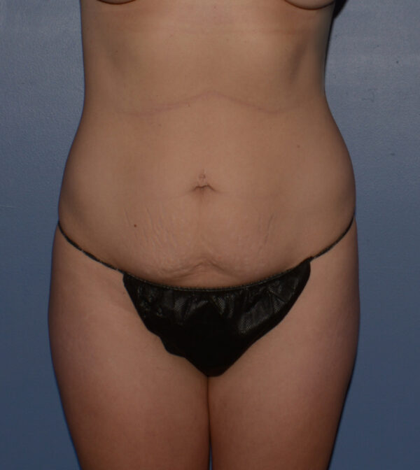 Tummy Tuck