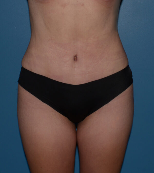 Tummy Tuck