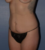 Tummy Tuck