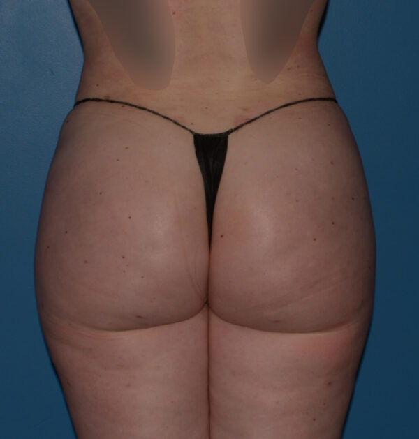 Brazilian Butt Lift