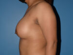 Breast Augmentation Implants