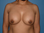 Breast Augmentation Implants