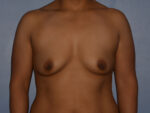 Breast Augmentation Implants