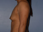 Breast Augmentation Implants