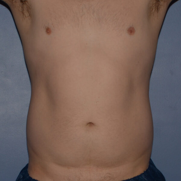 Liposuction