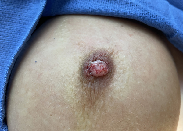 Inverted Nipple Repair