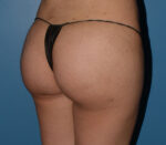 Brazilian Butt Lift