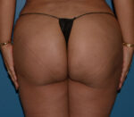 Brazilian Butt Lift