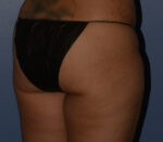 Brazilian Butt Lift