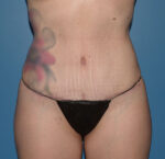Tummy Tuck