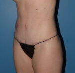 Tummy Tuck