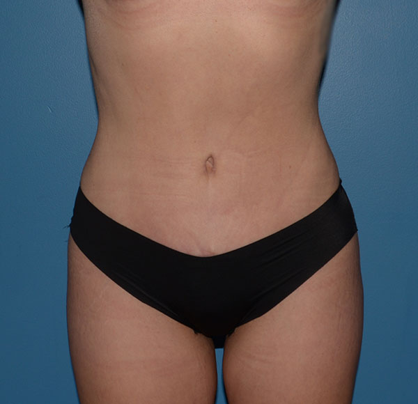 Tummy Tuck