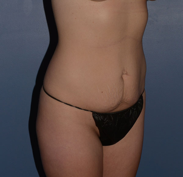 Tummy Tuck