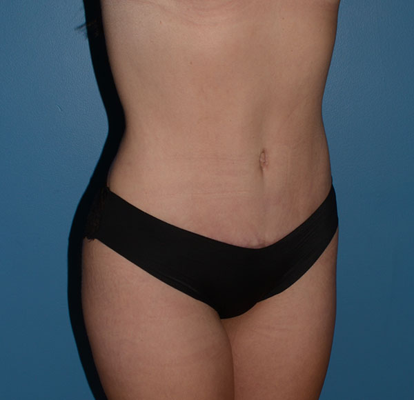 Tummy Tuck