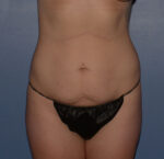 Tummy Tuck
