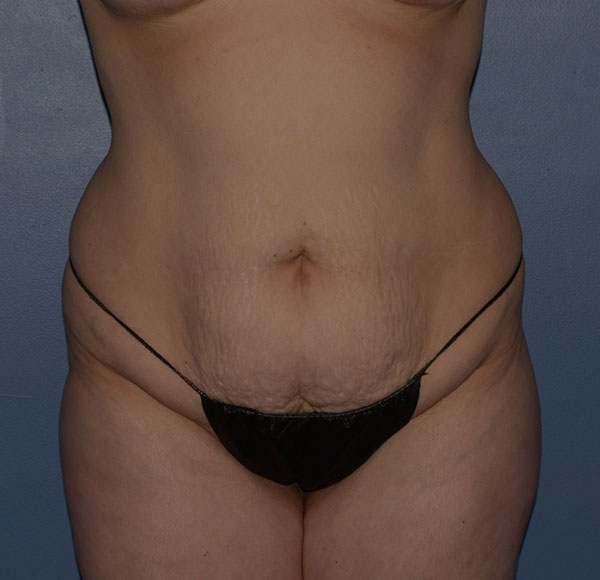 Tummy Tuck