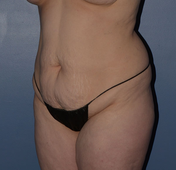 Tummy Tuck