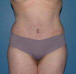 Tummy Tuck