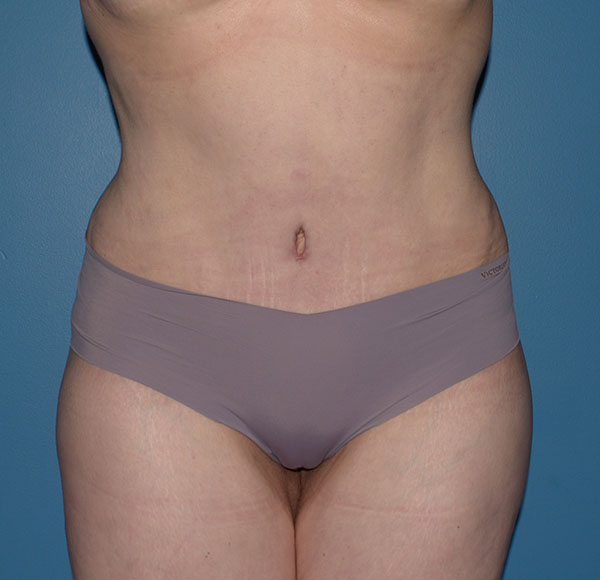 Tummy Tuck
