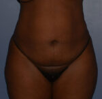 Tummy Tuck