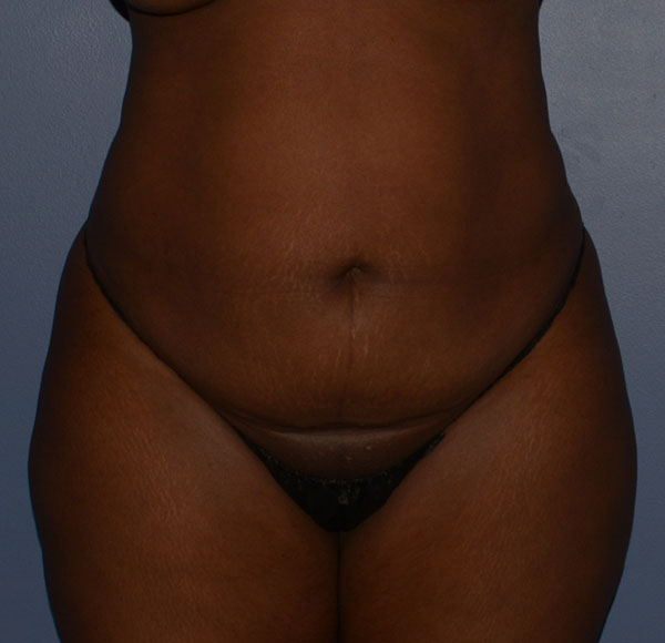 Tummy Tuck