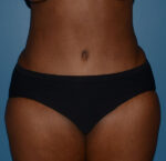 Tummy Tuck