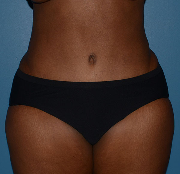 Tummy Tuck