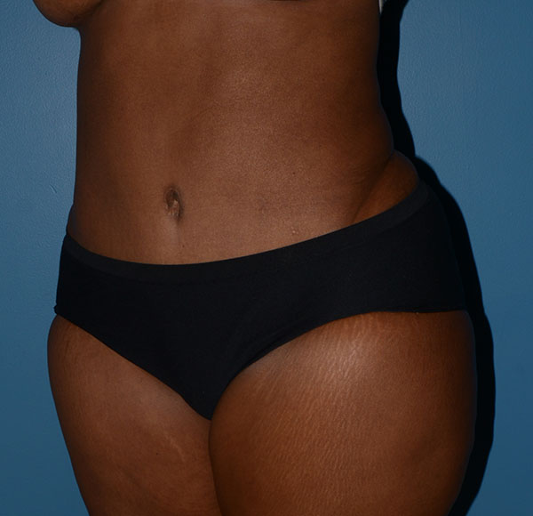 Tummy Tuck