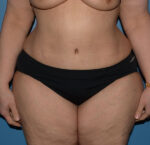 Tummy Tuck