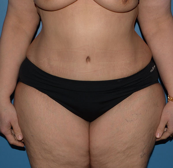 Tummy Tuck
