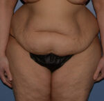Tummy Tuck