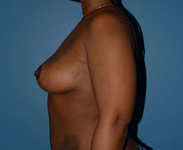 Breast Lift