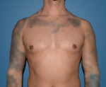 Male Breast Reduction