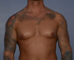 Male Breast Reduction