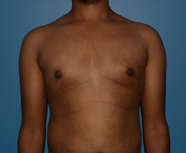 Male Breast Reduction