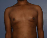 Male Breast Reduction