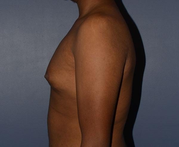 Male Breast Reduction