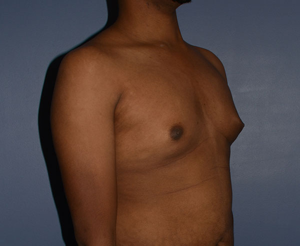 Male Breast Reduction