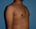 Male Breast Reduction