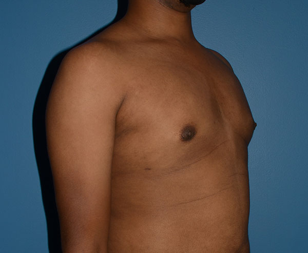 Male Breast Reduction